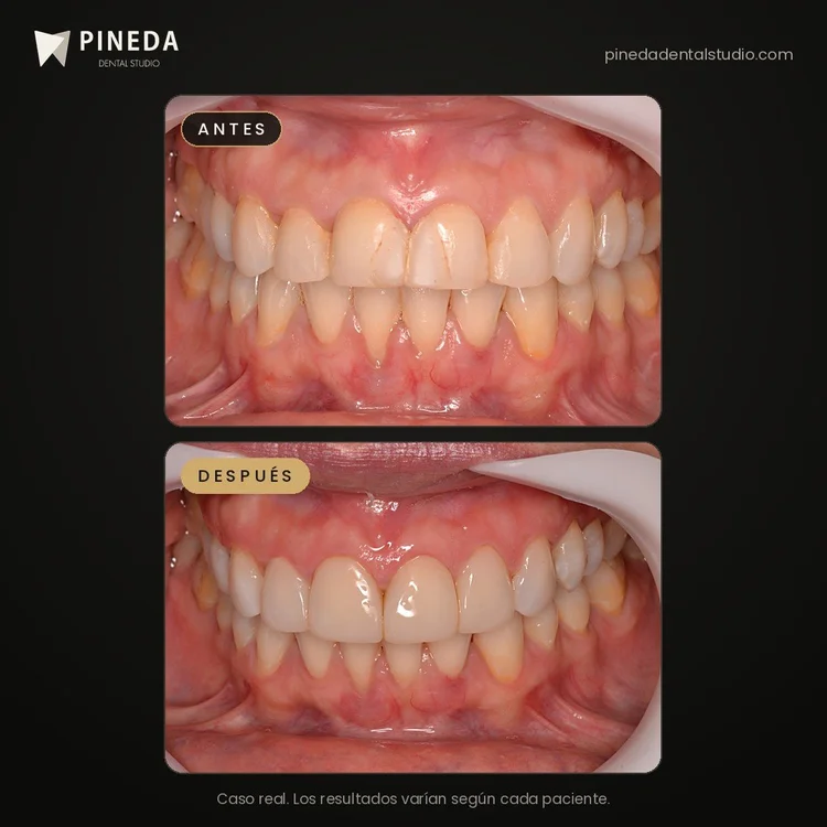 Antes y después de carillas de composite en dientes fisurados en Pineda Dental Studio, Recoleta, CABA.