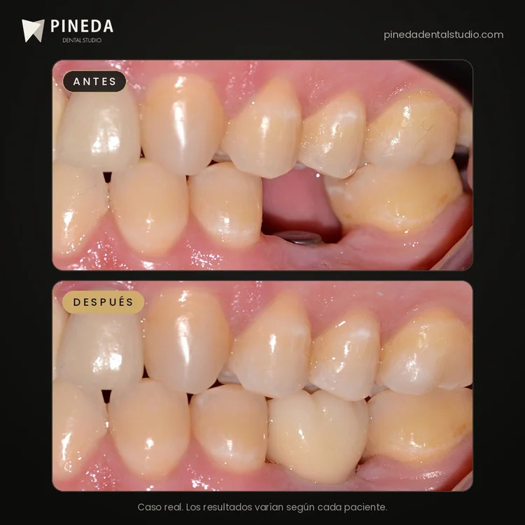Antes y después de un implante con corona en el sector posterior en Pineda Dental Studio, Recoleta, CABA.
