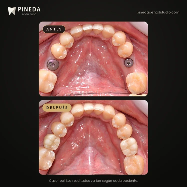 Antes y después de dos implantes dentales con sus coronas en el maxilar superior en Pineda Dental Studio, Recoleta, CABA