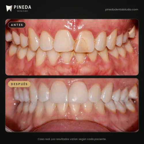 Antes y después de carillas de composite en un diente fracturado en Pineda Dental Studio, Recoleta, CABA