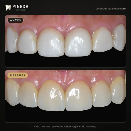 Antes y después de carillas de cerámica con aspecto natural en los dientes anteriores en Pineda Dental Studio, Recoleta, CABA