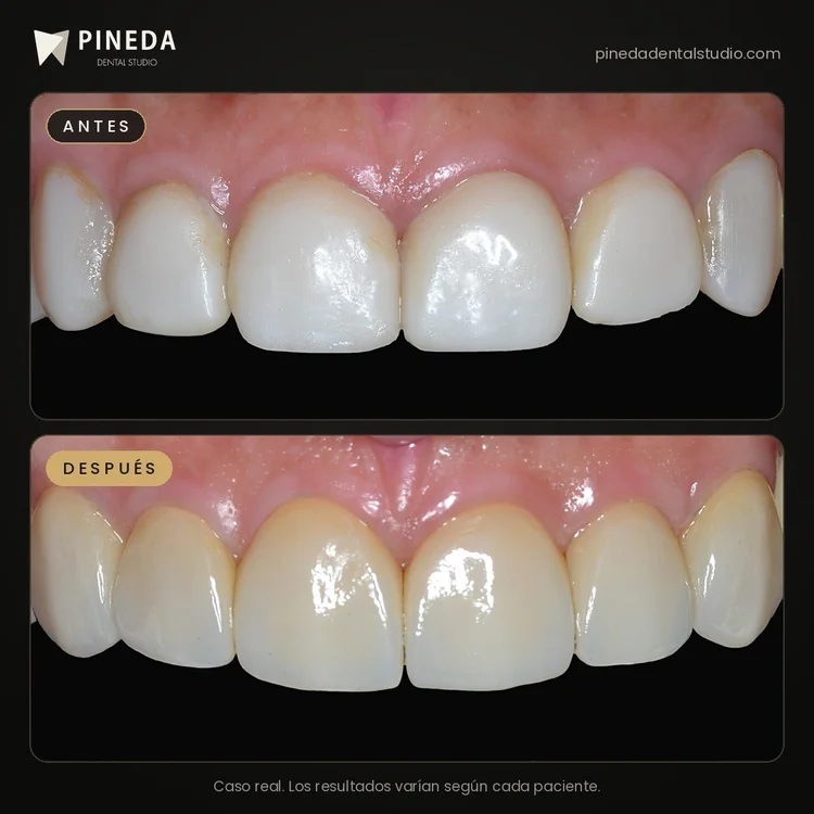 Antes y después de carillas de cerámica con aspecto natural en los dientes anteriores en Pineda Dental Studio, Recoleta, CABA.