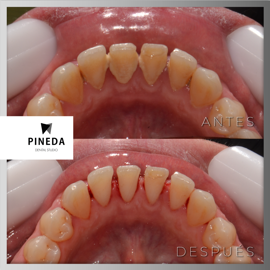 Comparativa clínica de un tratamiento de profilaxis dental profunda, mostrando la remoción de cálculo dental inferior en Recoleta CABA.