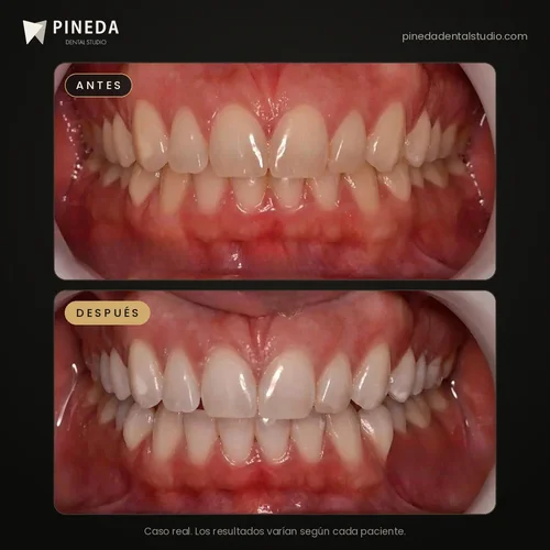 Antes y después de un blanqueamiento dental LED en Pineda Dental Studio, Recoleta, CABA