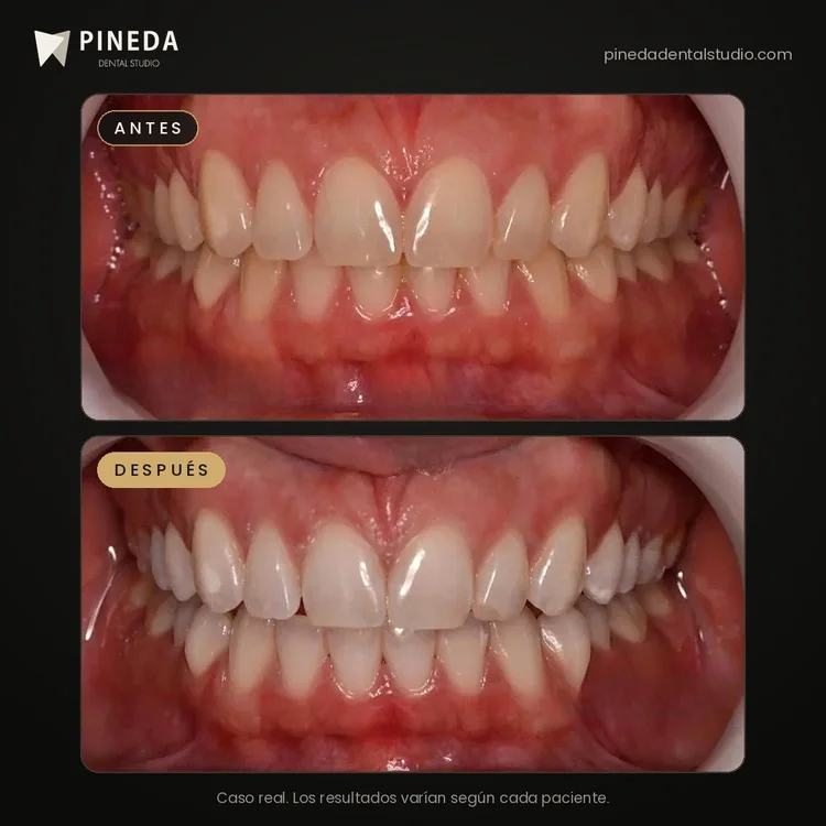 Antes y después de un blanqueamiento dental LED en Pineda Dental Studio, Recoleta, CABA.