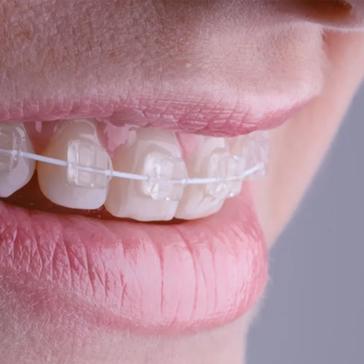 Primer plano de una paciente sonriendo con brackets estéticos transparentes durante su tratamiento de ortodoncia en Recoleta.