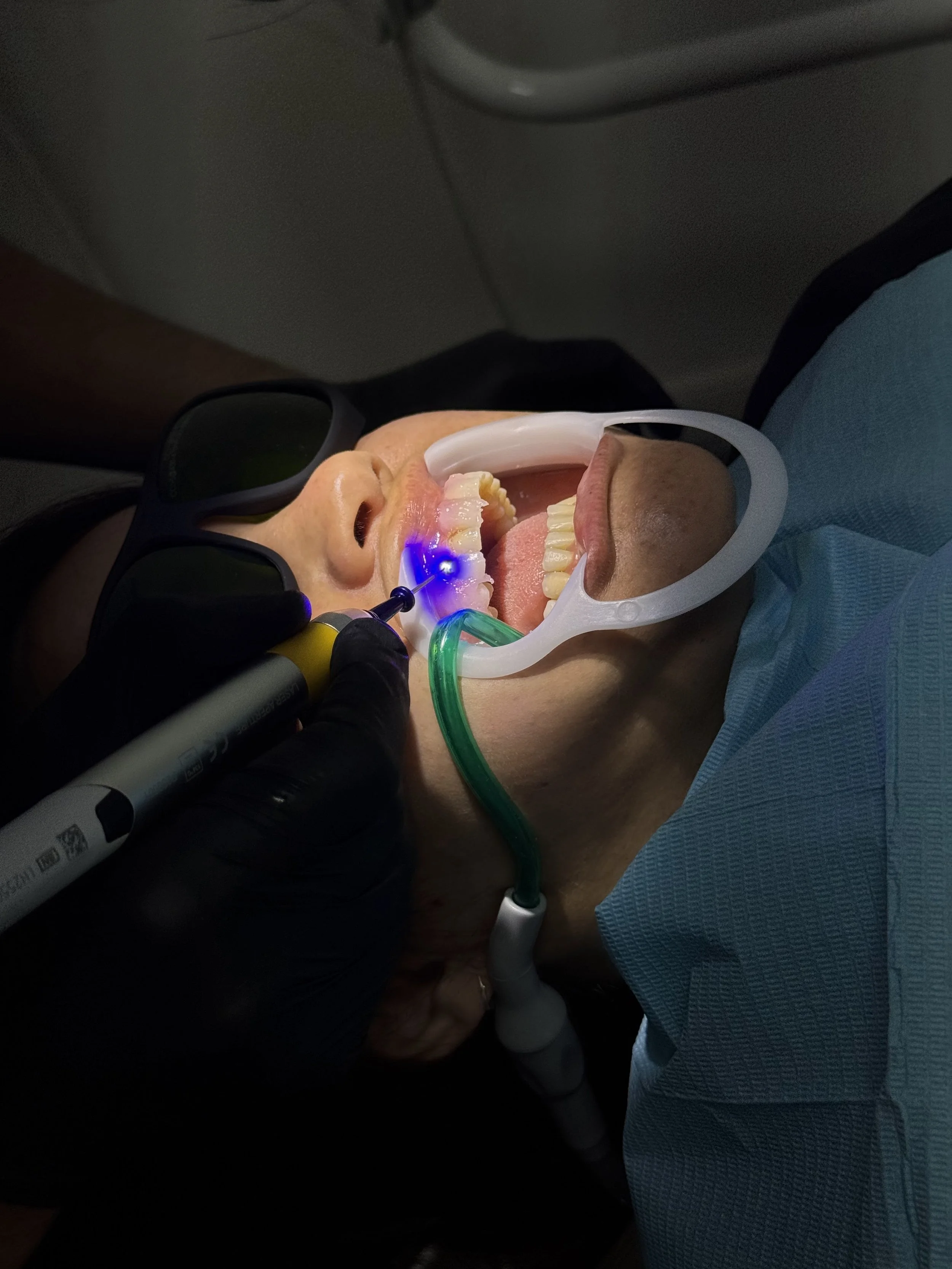 Especialista realizando una gingivoplastía mínimamente invasiva con láser de diodo para contornear las encías del paciente recoleta caba.