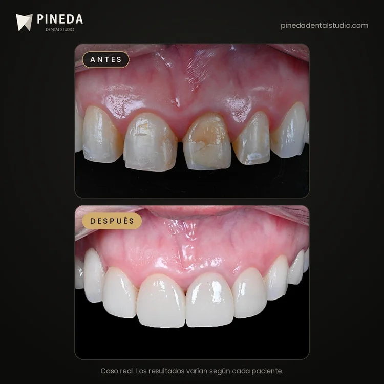 Antes y después de una rehabilitación con carillas de porcelana en Pineda Dental Studio, Recoleta, CABA.