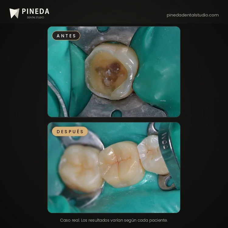 Antes y después de una incrustación de resina en un molar en Pineda Dental Studio, Recoleta, CABA.