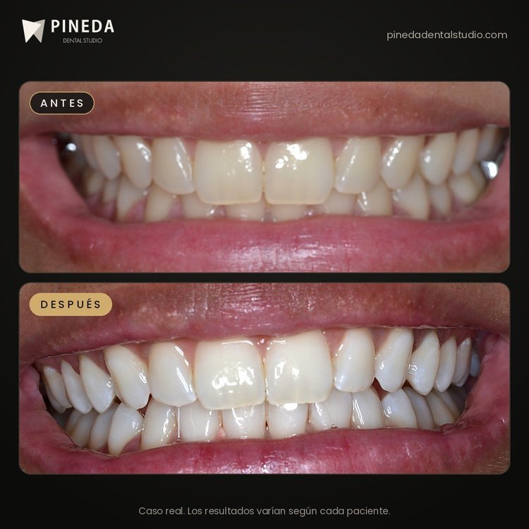 Antes y después de un blanqueamiento dental LED en 3 sesiones: vista de la sonrisa en Pineda Dental Studio, Recoleta, CABA.