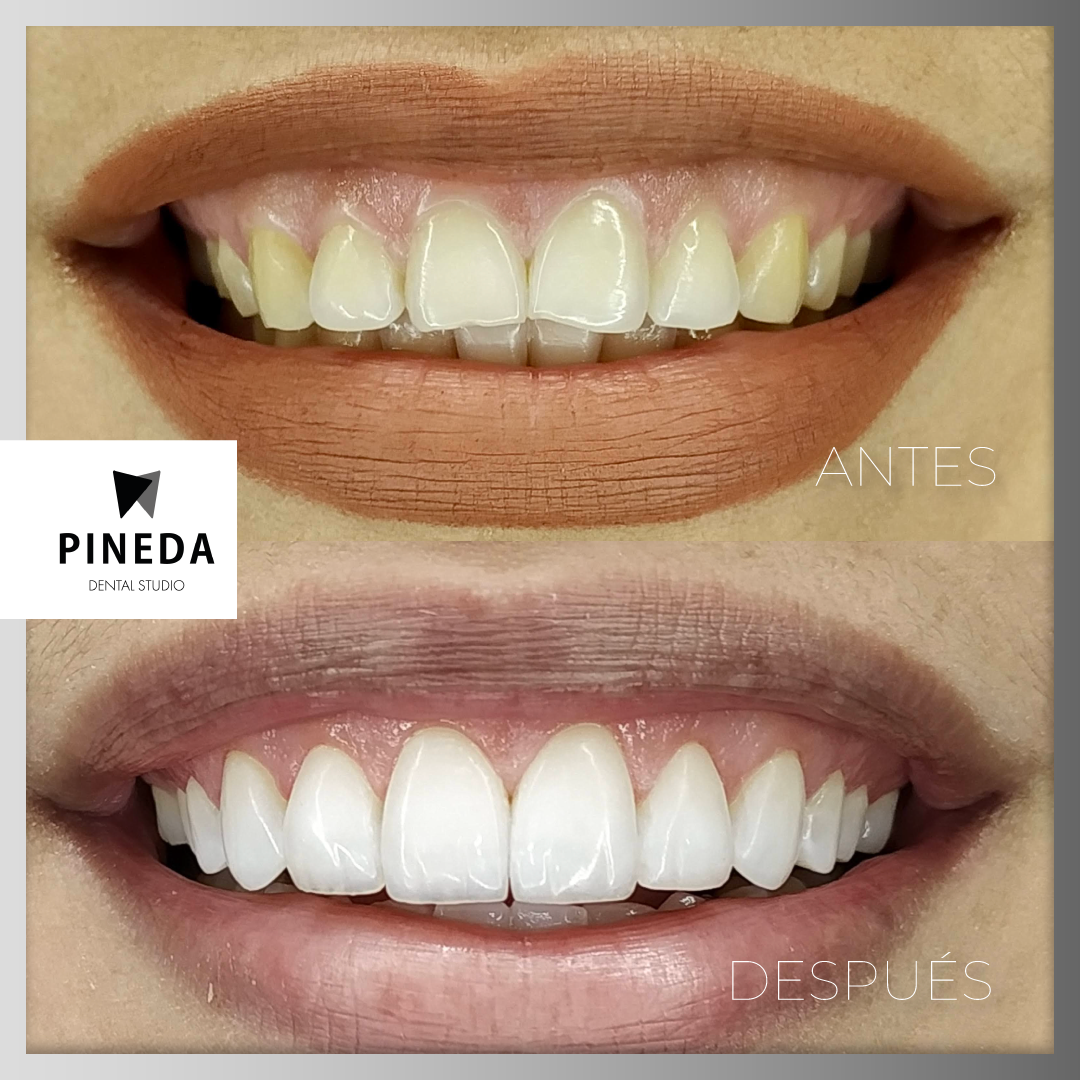 Diseño de sonrisa mínimamente invasivo: espectacular antes y después logrado con carillas de composite sin necesidad de desgastar el diente natural. CABA