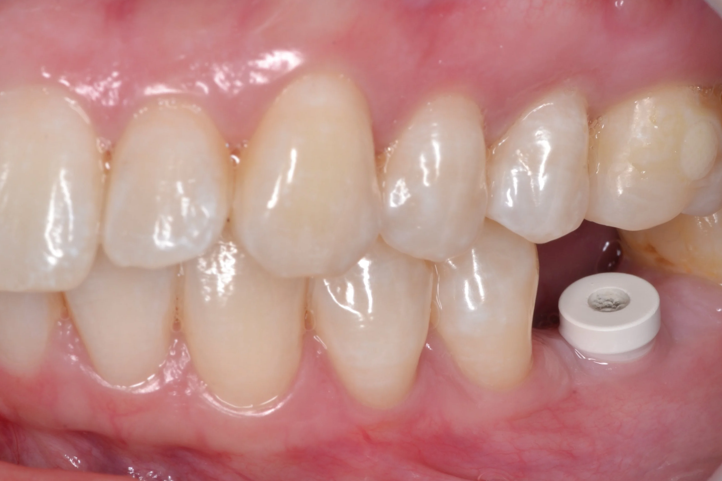 Comparativa clínica mostrando las etapas de rehabilitación con un implante dental: desde el pilar de cicatrización hasta la colocación de la corona definitiva de porcelana en Pineda Dental Studio, Recoleta - caba