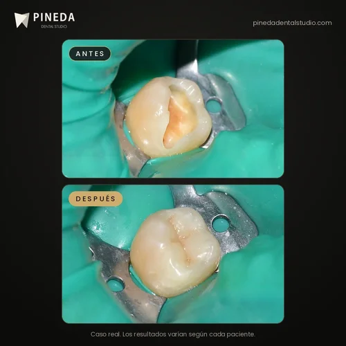 Antes y después de una incrustación estética en una muela con caries en Pineda Dental Studio, Recoleta, CABA