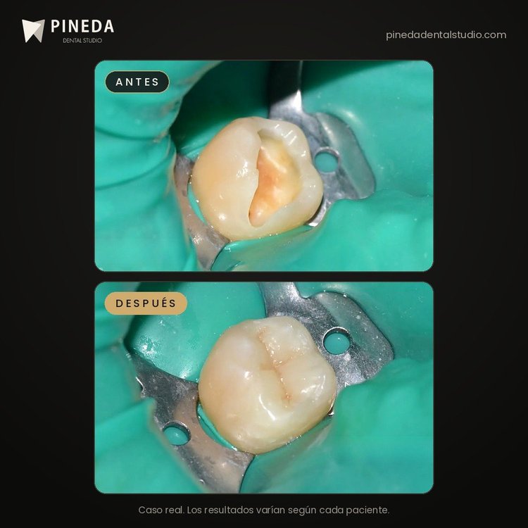 Antes y después de una incrustación en una muela muy destruida en Pineda Dental Studio, Recoleta, CABA.