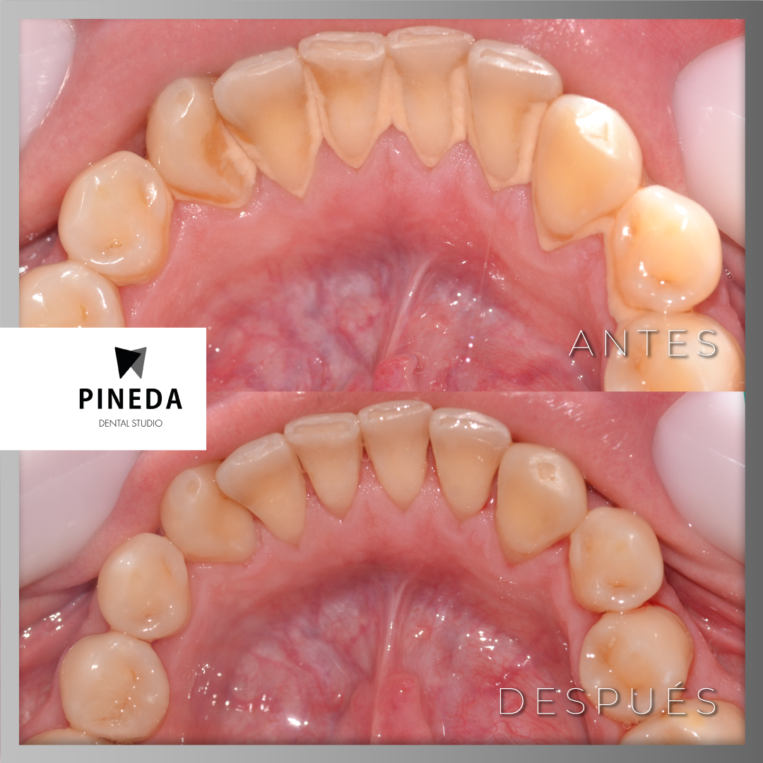 Antes y después de una limpieza dental profesional para eliminar la acumulación de sarro en la cara interna de los dientes en Pineda Dental Studio, Recoleta CABA.