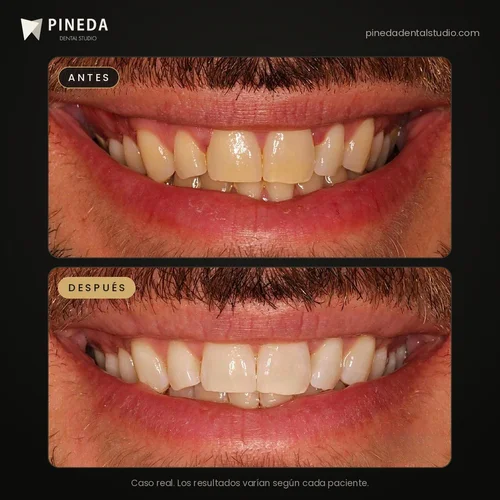 Antes y después de un blanqueamiento dental en consultorio en Pineda Dental Studio, Recoleta, CABA