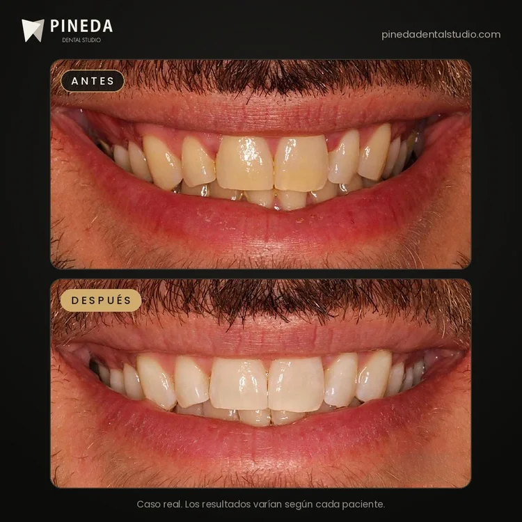 Antes y después de un blanqueamiento dental en consultorio en Pineda Dental Studio, Recoleta, CABA.