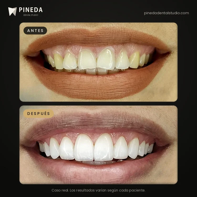 Antes y después de carillas de composite sin desgaste en Pineda Dental Studio, Recoleta, CABA.