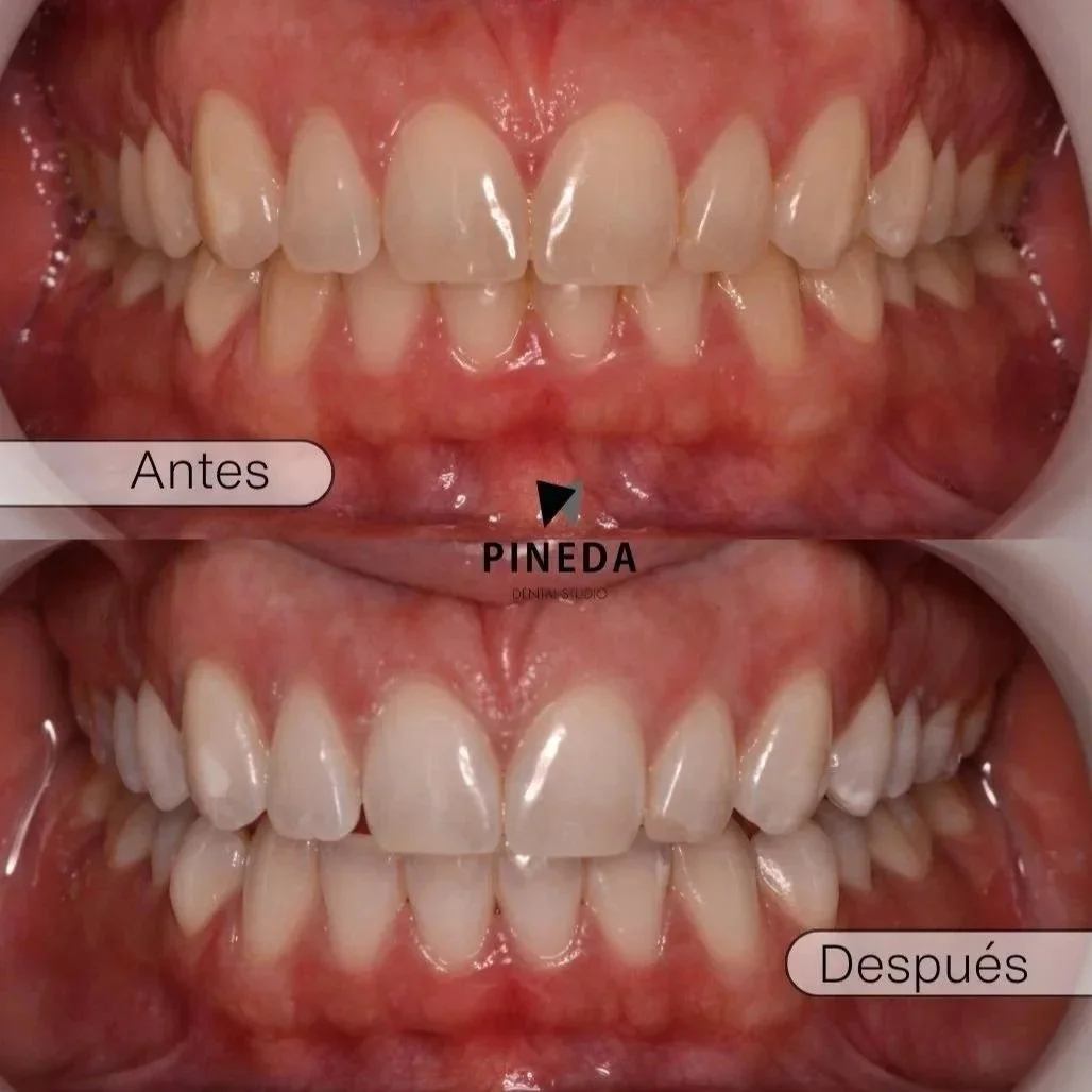 Comparativa de antes y después de un tratamiento de blanqueamiento dental con tecnología LED en Pineda Dental Studio, Recoleta - CABA