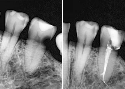 Radiografía dental del antes y después de un tratamiento de conducto (endodoncia) para curar una infección, realizado en Pineda Dental Studio en Capital Federal