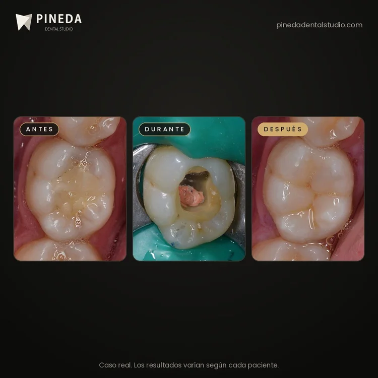 Antes, durante y después de la restauración de un molar en Pineda Dental Studio, Recoleta, CABA.