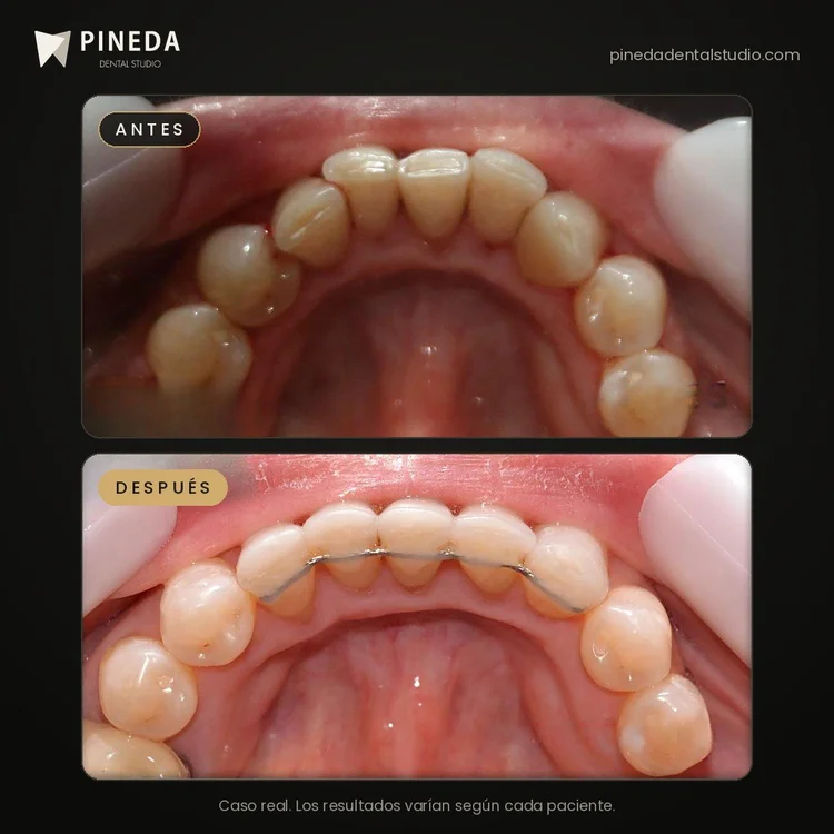 Antes y después de una ortodoncia con contención fija inferior en Pineda Dental Studio, Recoleta, CABA.
