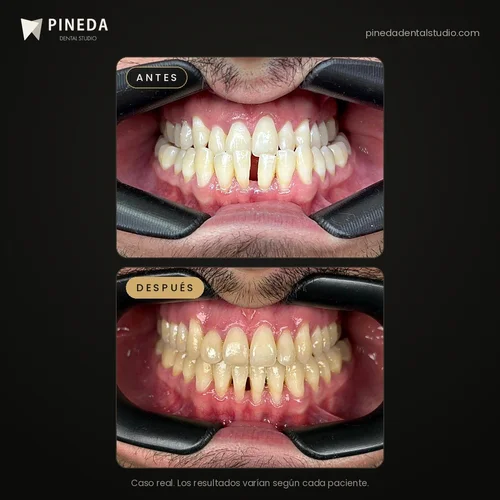 Antes y después del cierre de un diastema con ortodoncia en Pineda Dental Studio, Recoleta, CABA