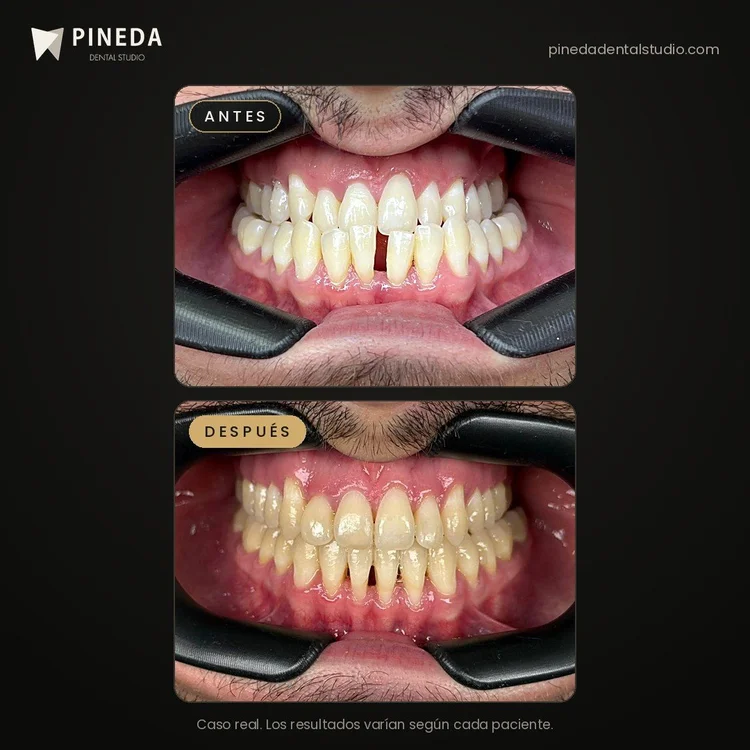 Antes y después del cierre de un diastema con ortodoncia en Pineda Dental Studio, Recoleta, CABA.