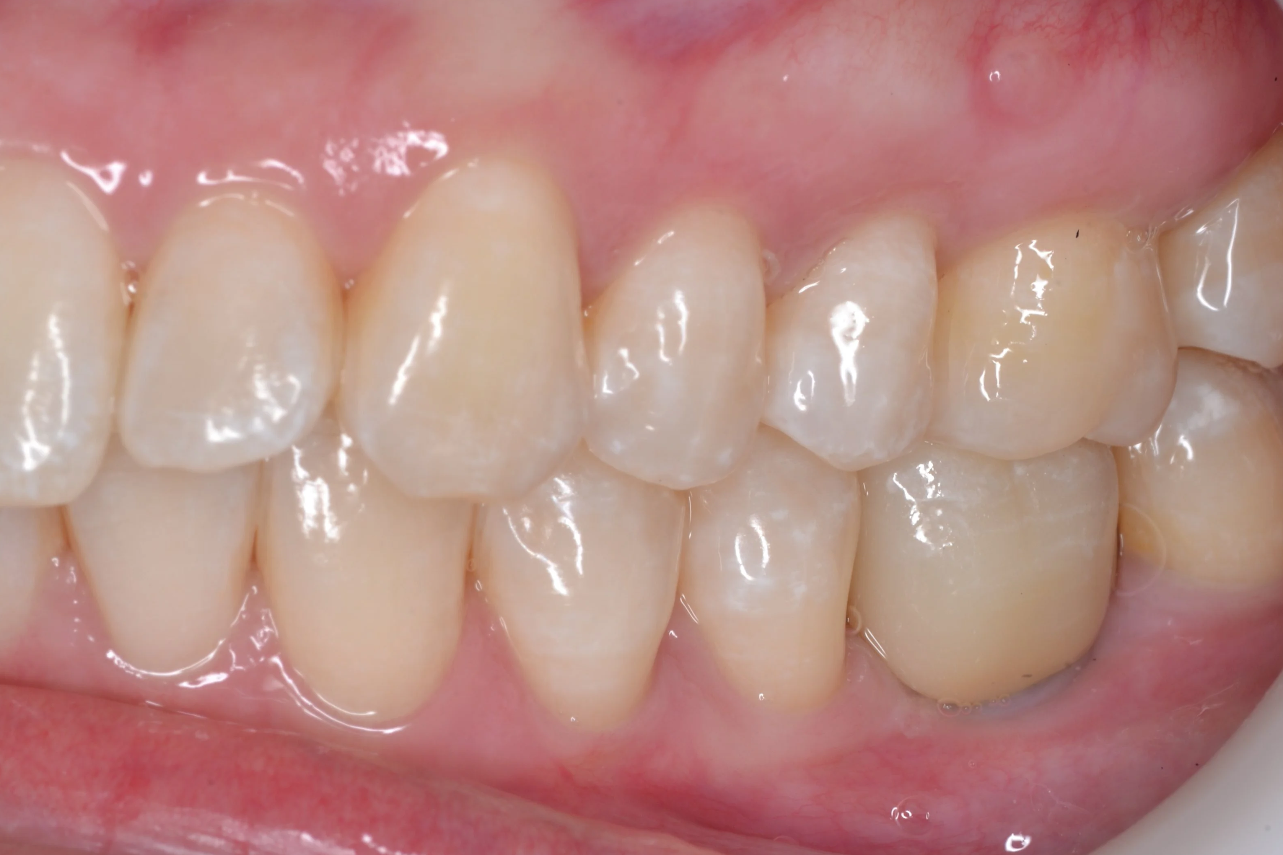Comparativa clínica mostrando las etapas de rehabilitación con un implante dental: desde el pilar de cicatrización hasta la colocación de la corona definitiva de porcelana en Pineda Dental Studio, Recoleta-caba