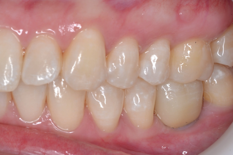 Antes y después de una corona de porcelana sobre implante dental, en Pineda Dental Studio, Recoleta, CABA.