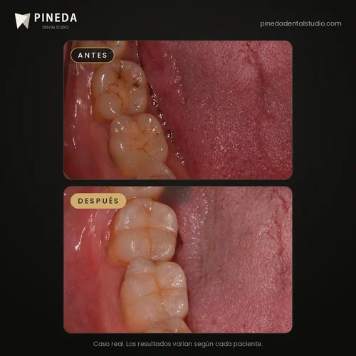 Antes y después de resinas por caries en molares en Pineda Dental Studio, Recoleta, CABA