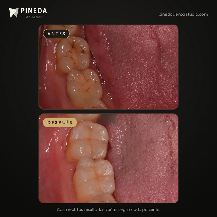 Antes y después de resinas por caries en molares en Pineda Dental Studio, Recoleta, CABA.