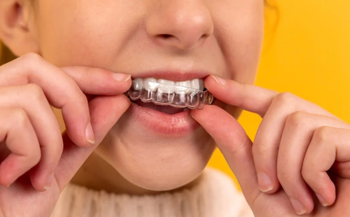 Primer plano de una paciente colocando un alineador de ortodoncia invisible transparente en sus dientes superiores, tratamiento disponible en Pineda Dental Studio, Recoleta