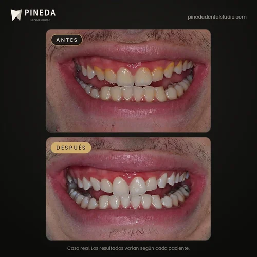Antes y después de limpieza de sarro y blanqueamiento dental en Pineda Dental Studio, Recoleta, CABA
