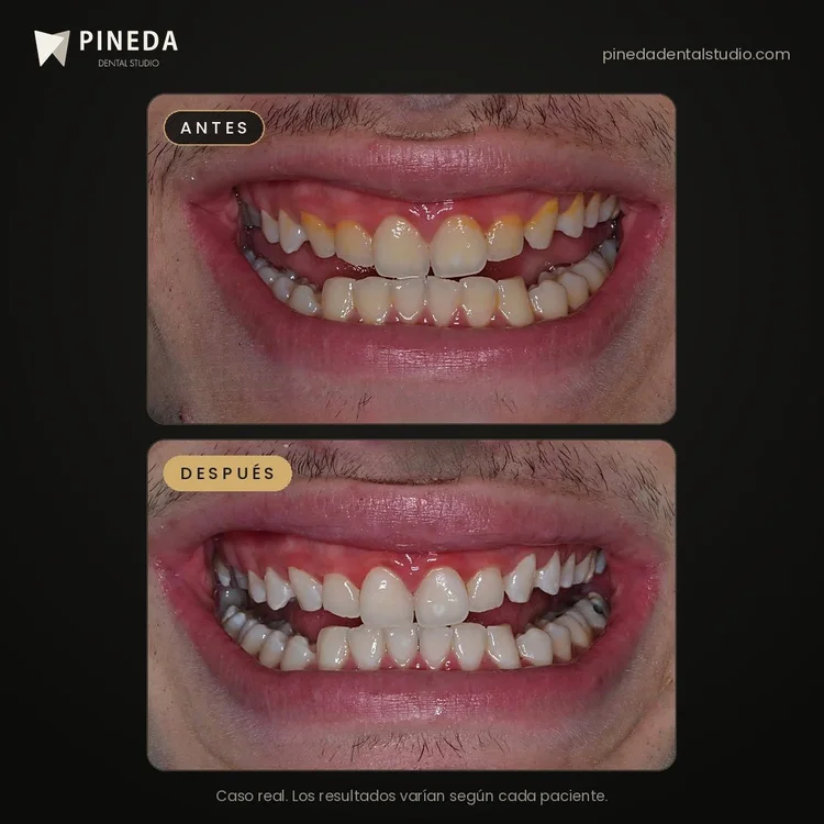 Antes y después de una limpieza de sarro y blanqueamiento dental en Pineda Dental Studio, Recoleta, CABA.