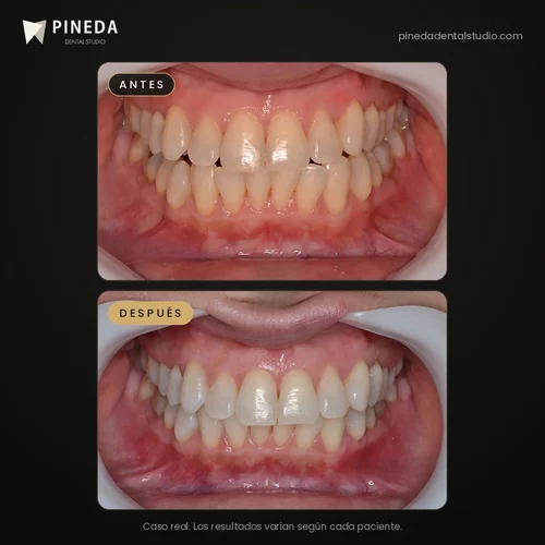Antes y después de un blanqueamiento dental con láser de diodo en Pineda Dental Studio, Recoleta, CABA