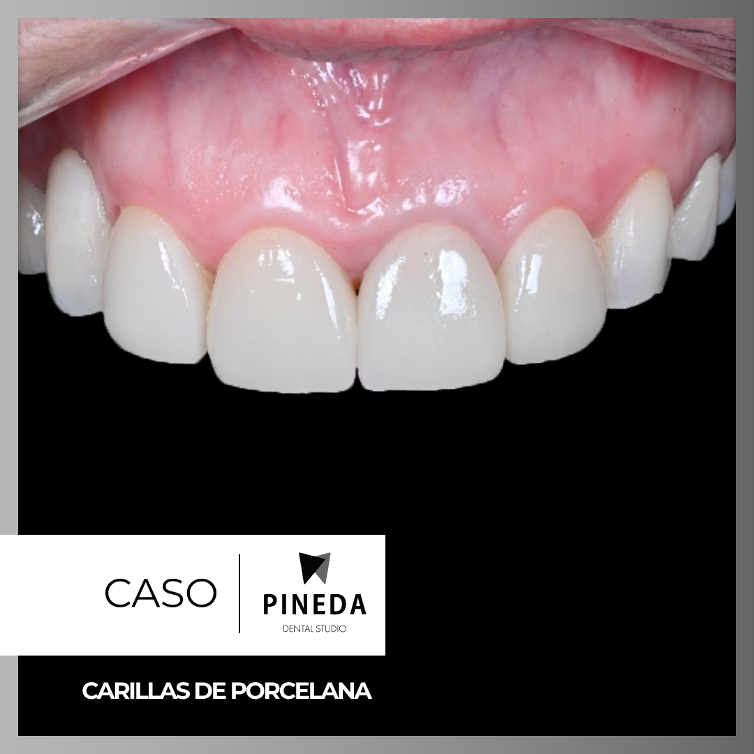 Comparativa clínica de antes y después mostrando una notable transformación estética mediante un diseño de sonrisa con carillas de porcelana en Pineda Dental Studio, Recoleta-caba.
