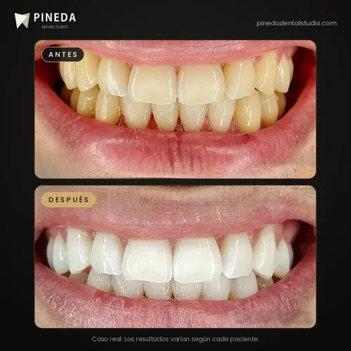 Antes y después de un blanqueamiento dental clínico en Pineda Dental Studio, Recoleta, CABA