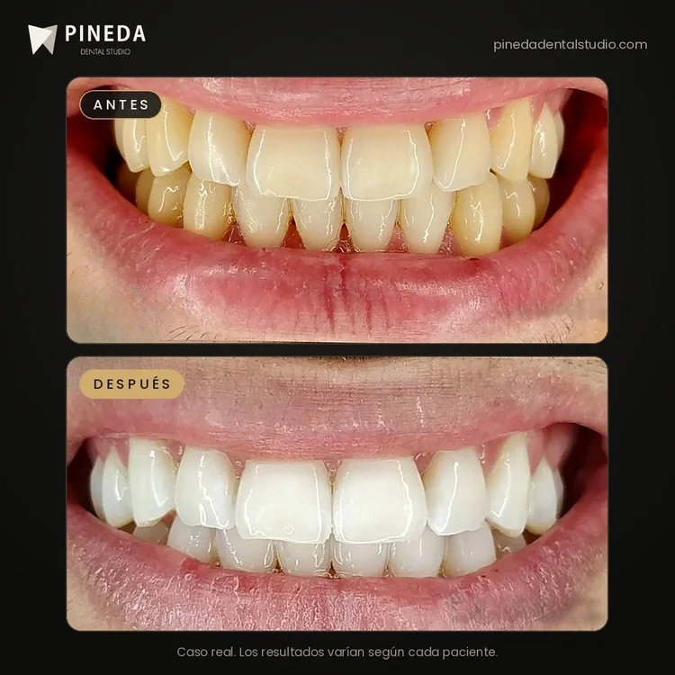 Antes y después de un blanqueamiento dental clínico en Pineda Dental Studio, Recoleta, CABA.