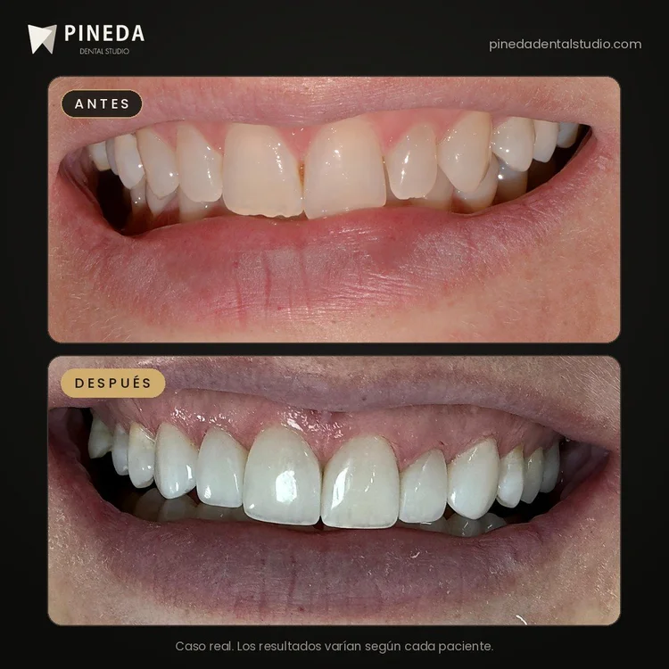 Antes y después de carillas dentales en el maxilar superior en Pineda Dental Studio, Recoleta, CABA.