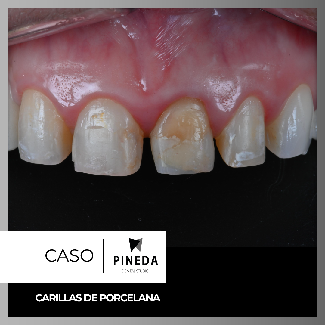 Comparativa clínica de antes y después mostrando una notable transformación estética mediante un diseño de sonrisa con carillas de porcelana en Pineda Dental Studio, Recoleta - caba.