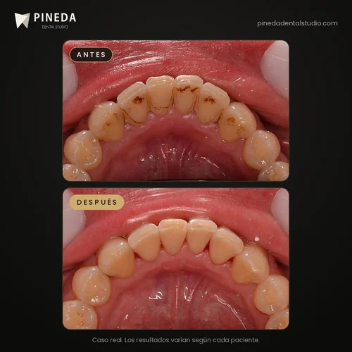 Antes y después de una limpieza dental con aeropulidor: sarro y manchas en Pineda Dental Studio, Recoleta, CABA