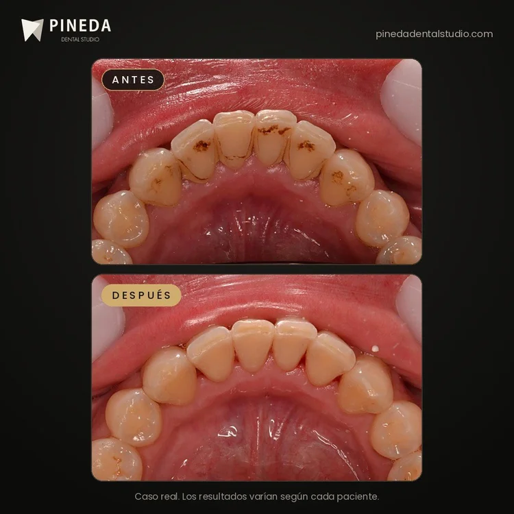 Antes y después de una limpieza dental con aeropulidor: sarro y manchas en Pineda Dental Studio, Recoleta, CABA.