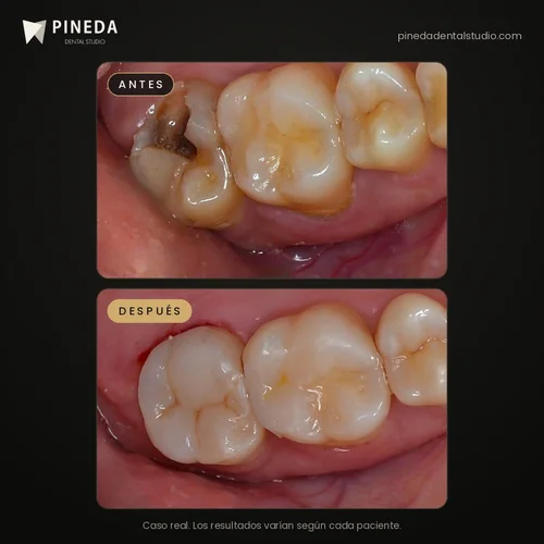 Antes y después de una incrustación de composite en una muela en Pineda Dental Studio, Recoleta, CABA