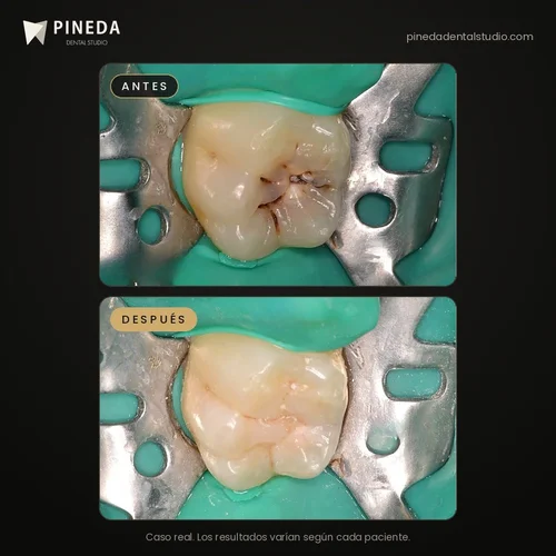 Antes y después de una caries tratada con composite estético en Pineda Dental Studio, Recoleta, CABA