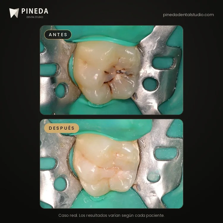 Antes y después de una caries tratada con composite estético en Pineda Dental Studio, Recoleta, CABA.