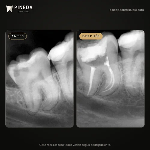 Radiografías antes y después de un tratamiento de conducto en raíces curvas en Pineda Dental Studio, Recoleta, CABA