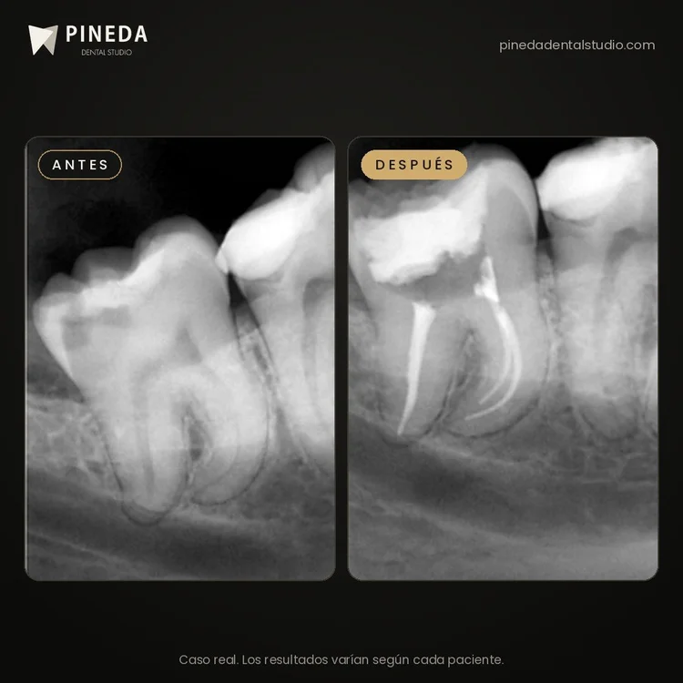 Radiografías antes y después de un tratamiento de conducto en raíces curvas en Pineda Dental Studio, Recoleta, CABA.