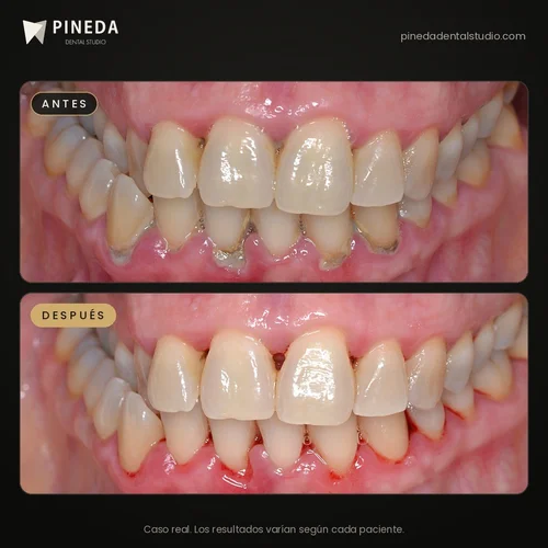 Antes y después de la primera etapa de una terapia básica periodontal con eliminación de sarro en Pineda Dental Studio, Recoleta, CABA