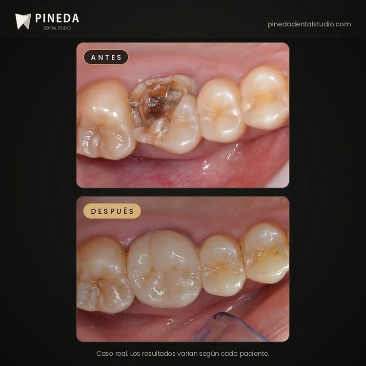 Antes y después de una incrustación en un molar en Pineda Dental Studio, Recoleta, CABA.